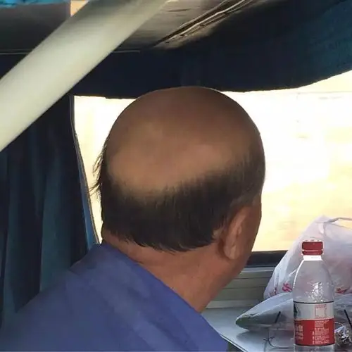 中国大爷秃顶观察