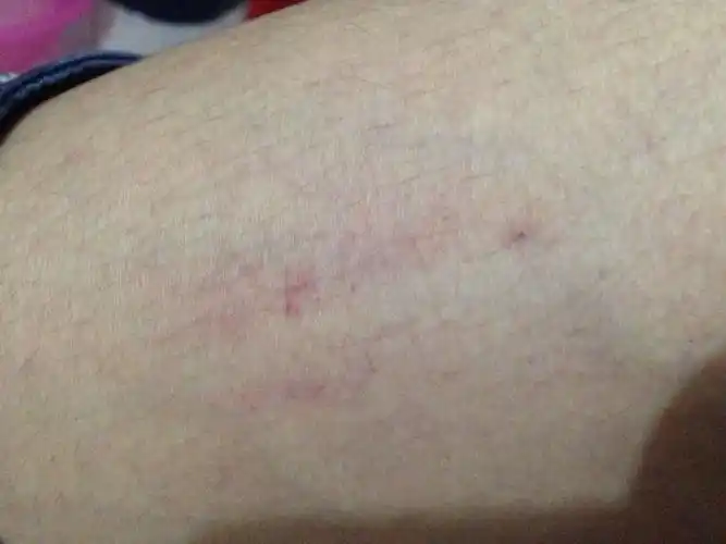 男,今天起床,发现大腿有几处长着血点,一点一点的,一片红红的,怎么