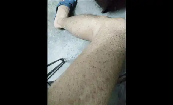 背部长黑斑要什么原因