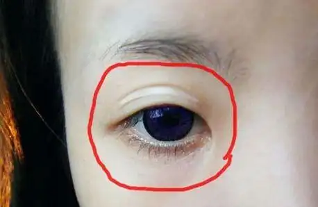 死鱼眼是什么样的死鱼眼面相解析