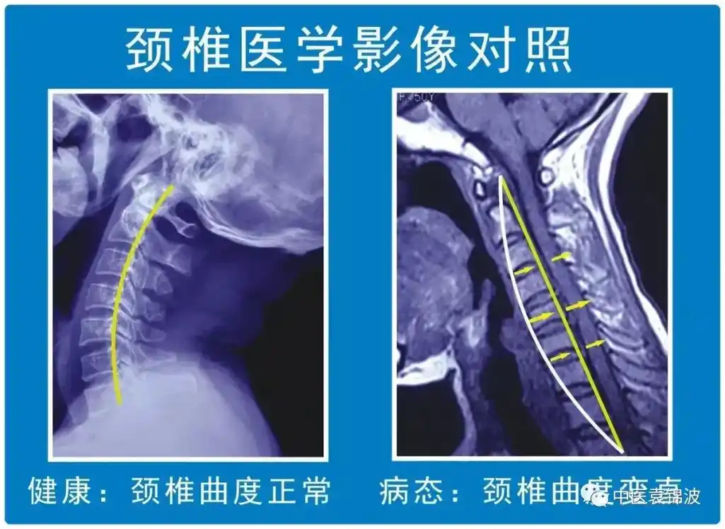 低头对颈椎的影响#弘扬传承传统中医文化 #关注健康关注我 - 抖音
