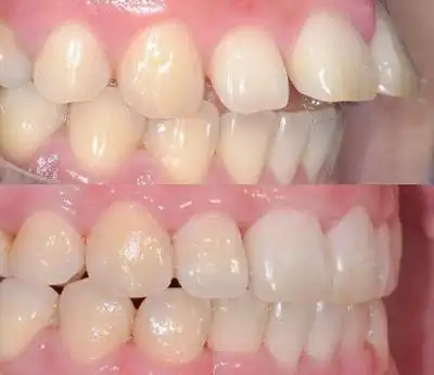 龅牙矫正前后对比