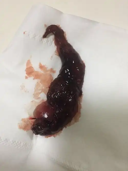 自然流产图片赏析原创