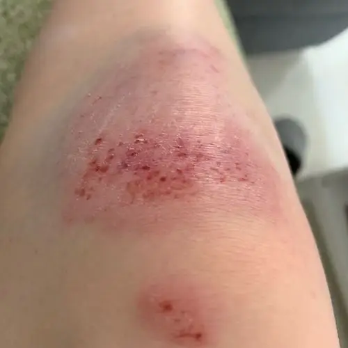 请问这样的摔伤擦伤,大概要几天会好?