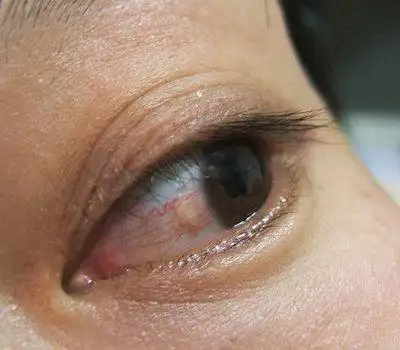 求救:我白色眼球部分长了个点状黄色小球斑状,不知道啥东西,有照片