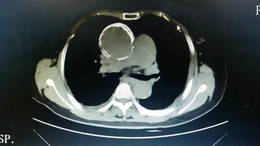 鸡蛋壳样升主动脉瘤 - 好大夫在线