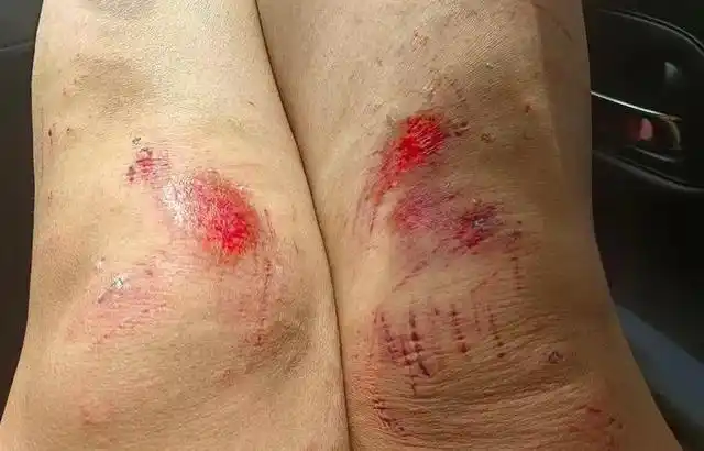 张女士(化姓)腿部因翻船被擦伤栾川县文化广电和旅游局工作人员对天目