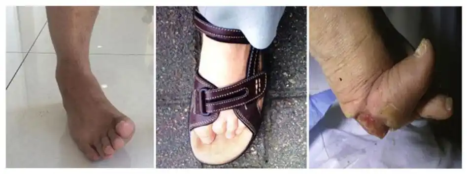 38%的帕金森病患者合并有肌张力障碍,包括马蹄内翻足,上肢屈曲,躯干