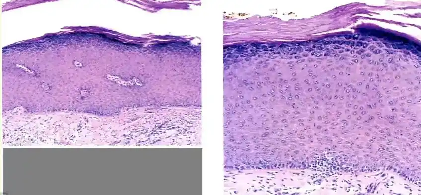 【衡道丨笔记】阴茎鳞状上皮增生性病变病理诊断(第一讲)|上皮|细胞