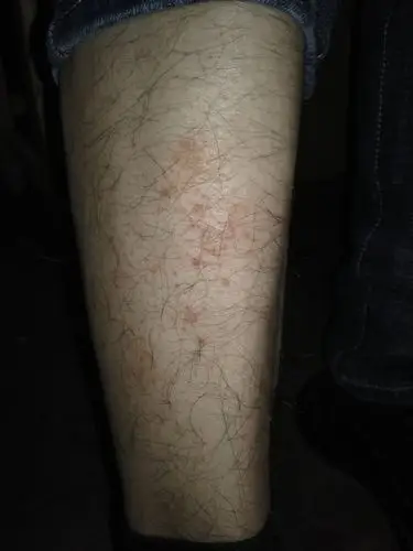 如图,腿上的是湿疹吗,那3样药能治吗?