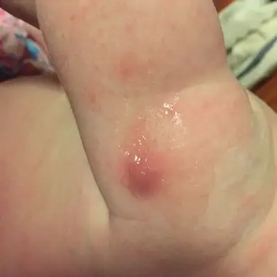 使用 残忍拒绝 推荐回答              这是第一次打卡介苗都会有包的