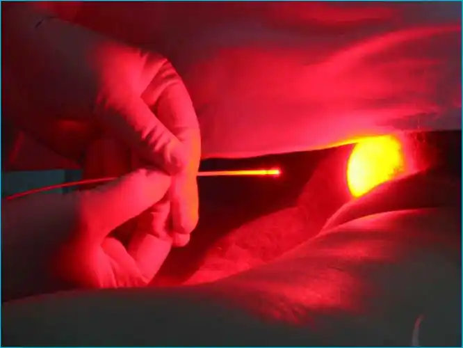 光动力治疗肿瘤