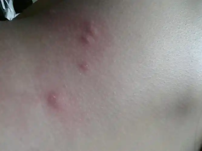 想确定肩上的包是什么虫咬的