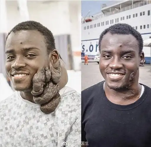 神经纤维瘤病为常染色体显性遗传病,是基因. 来自蓝莓医生 - 微博