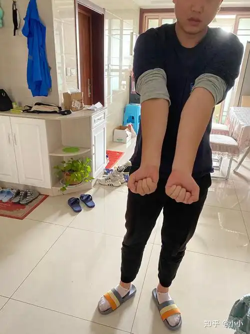 小小 的想法: 我这个算肘外翻吗 能过军检吗 #参军# - 知乎