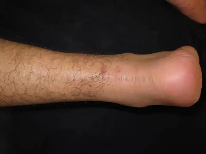 脚筋断了人就废了其实很多人的跟腱是被自己搞断的