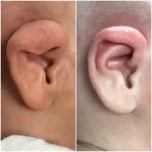 耳形态畸形及治疗效果 - 美篇