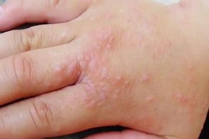 手癣图片初期症状图片大全_有来医生