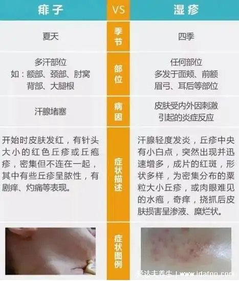 喜讯!一张图教你区别湿疹和痱子"同甘共苦"-第1张图片-王科博客
