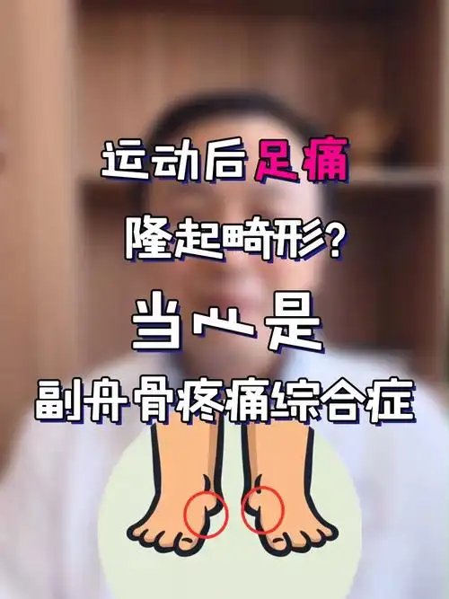 运动后足痛当心是副舟骨疼痛综合症