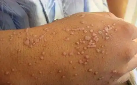 扁平疣常见的症状表现