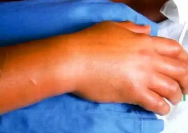 大内久:遭核辐射后强行救治83天,看着自己腐烂,求安乐死被拒|日本