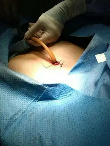 要不要结扎女人为什么不愿意结扎过来人的经验告诉你