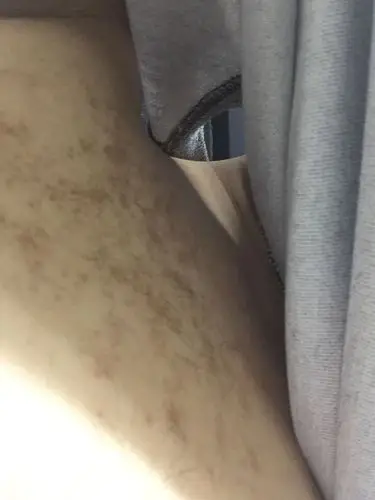 胸口有一些暗红色的斑点不疼不痒