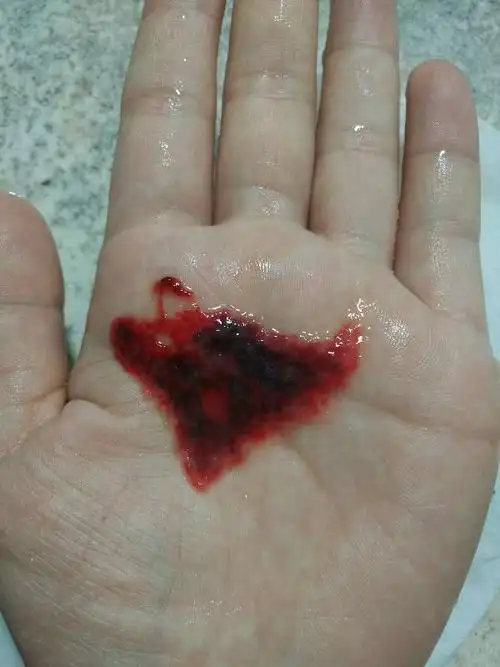 月经腹痛(之前都不这么痛的),然后感觉一大股涌出,带出一个大血块