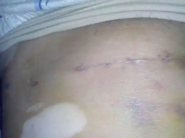 我在8月23日做了子宫肌瘤手术后,感觉这几天伤口周围发硬,并觉得内部