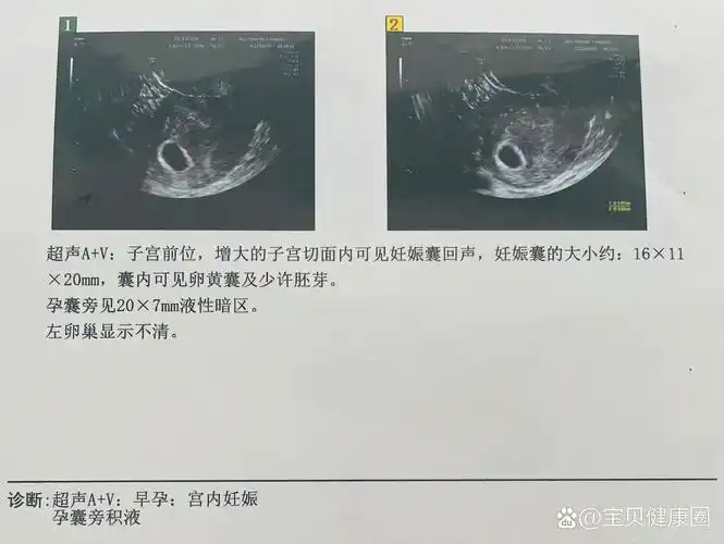 要慌～～ 🤰5w周末的时候大姨妈推迟,测出怀孕之后大夫就给开了b超