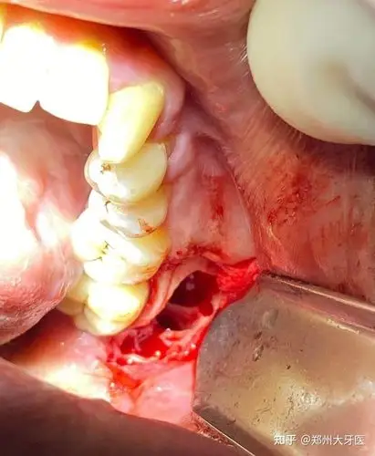 骨埋伏智齿拔出 - 知乎