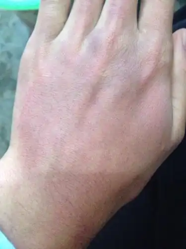 双手手背一片红,不痛不痒,医生看了说是湿