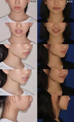 嘴突少女变女神,牙齿矫正比你想象的更加神奇