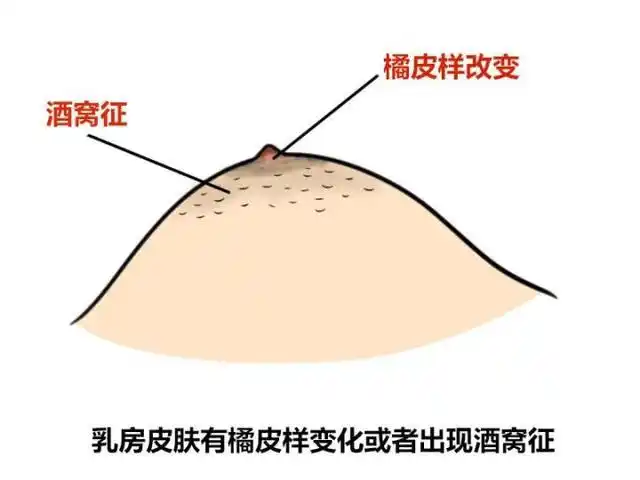 3如果乳头深部有癌肿,癌肿侵入乳腺管收缩牵拉乳头就会出现凹陷.