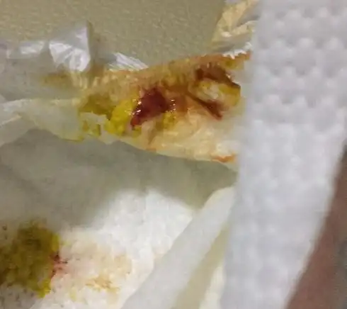 宝宝痔疮初期图片 (15)_有来医生