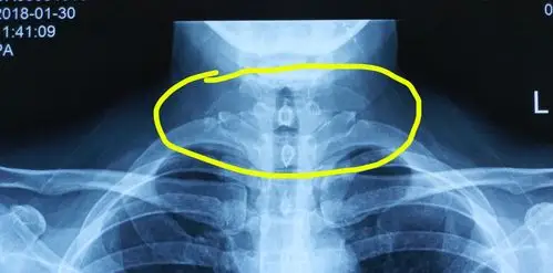 x线片:第7颈椎的双侧横突过长.