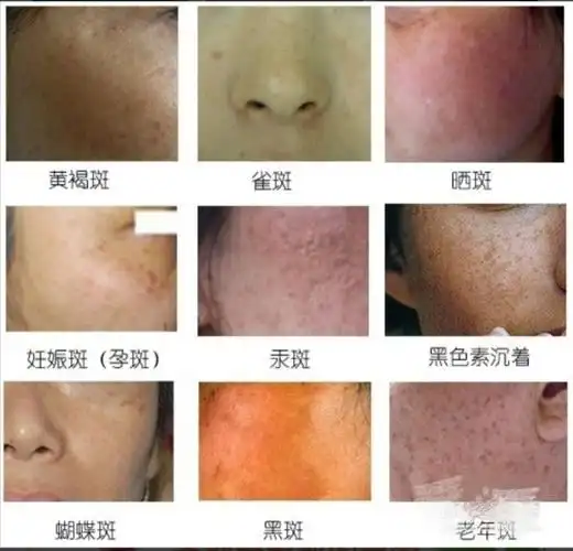 色斑的种类色斑的科普