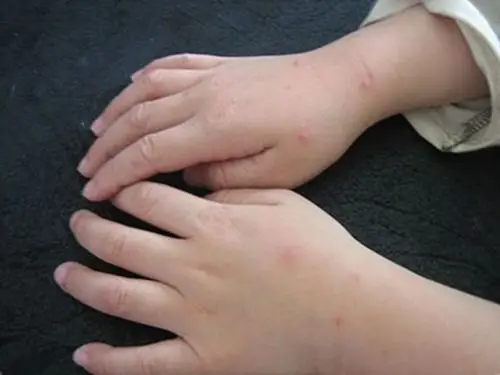 孩子患上手足口病后的症状是什么呢图片_有来医生