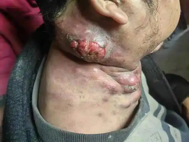 警示性科普/慎入!艾滋病"炸"图