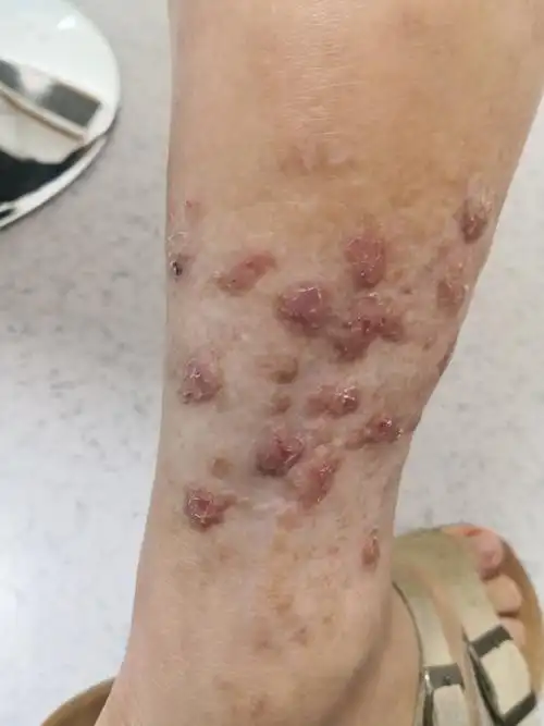 结节性痒疹##特应性皮炎##解决皮肤问题专注皮肤美容