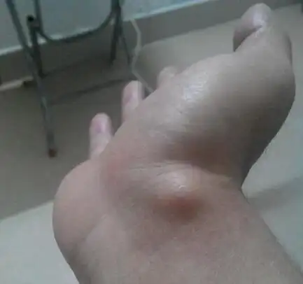 由于腱鞘外层很致密,而其薄弱部位往往面积又很小,所以,囊肿形成后在