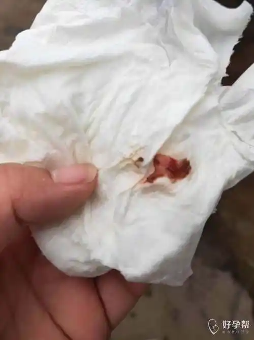 宫腔镜检查以后20天阴道里洗出来像肉肉的东西