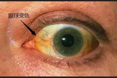 肝病眼球变色
