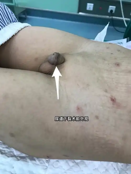 snodgrass术治疗尿道下裂 - 好大夫在线