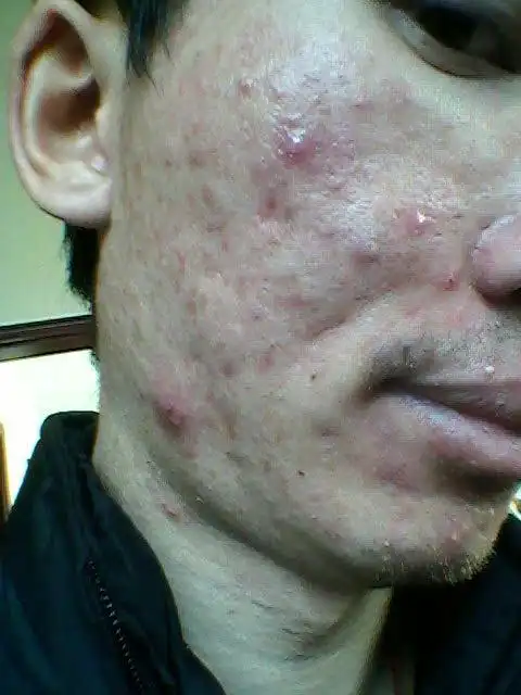 两边脸的痘痘长得很厉害,说毁容都不为过,现在很烦恼,求治疗啊.