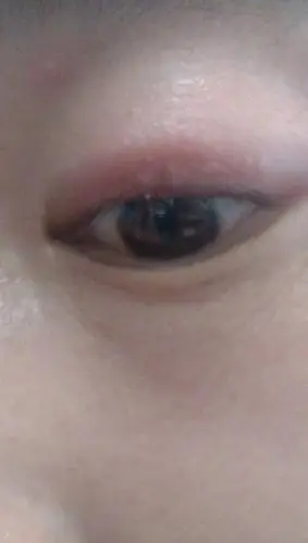 眼睫毛肿有白色浓状水泡怎么办?求高人指点谢谢