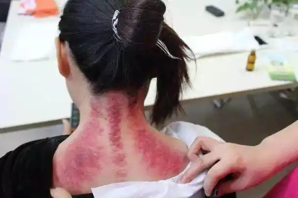 颈椎病刮痧方法图解刮痧对颈椎有好处吗