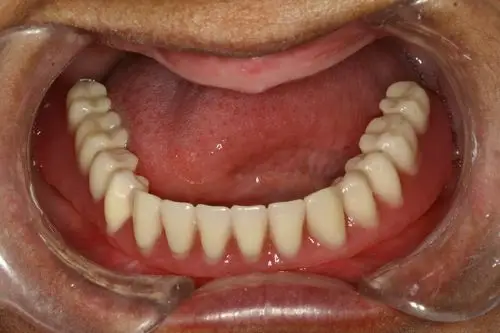 全口牙列缺失治疗活动全口义齿