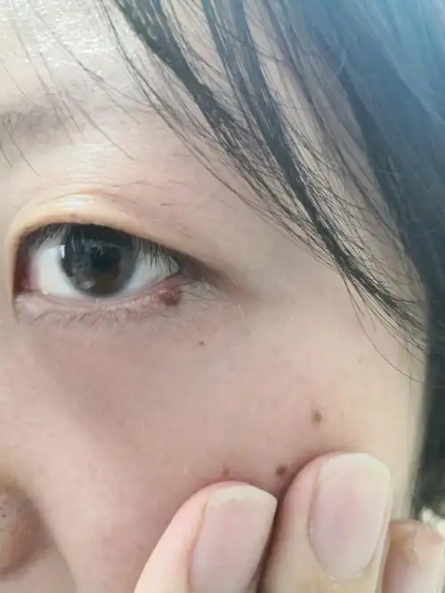 面部散发点状片状黑褐色斑片.色素痣症状.